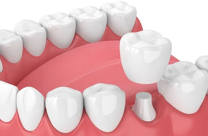 Dental Crowns in Round Rock, TX