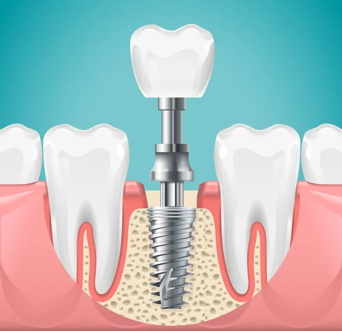 Dental Implants in Round Rock, TX
