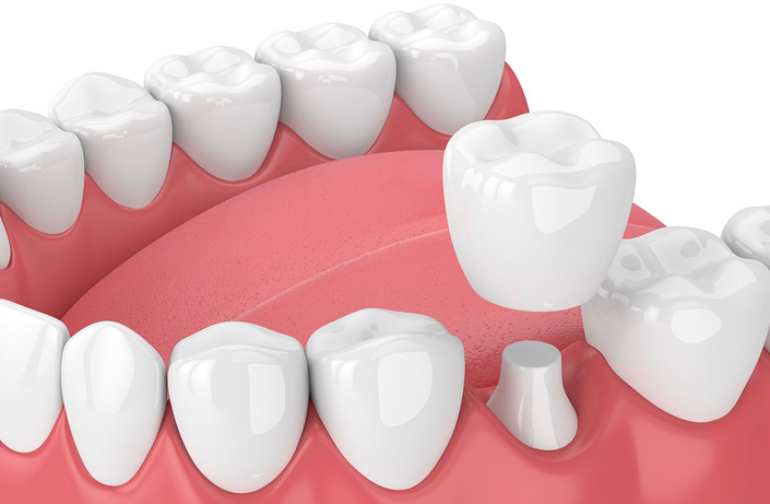 Dental Crowns in Round Rock, TX - Chandler Creek Dental Care