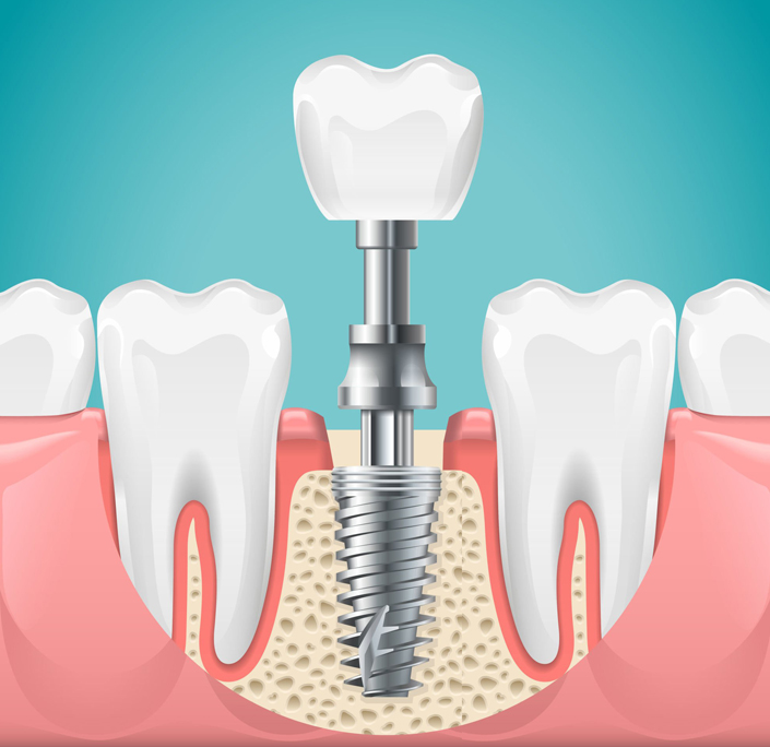 Dental Implants in Round Rock, TX - Chandler Creek Dental Care