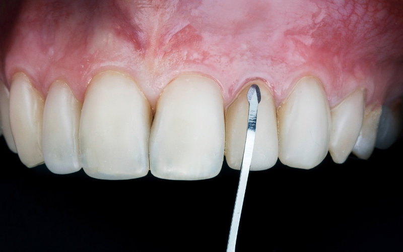 do gums grow back after implants