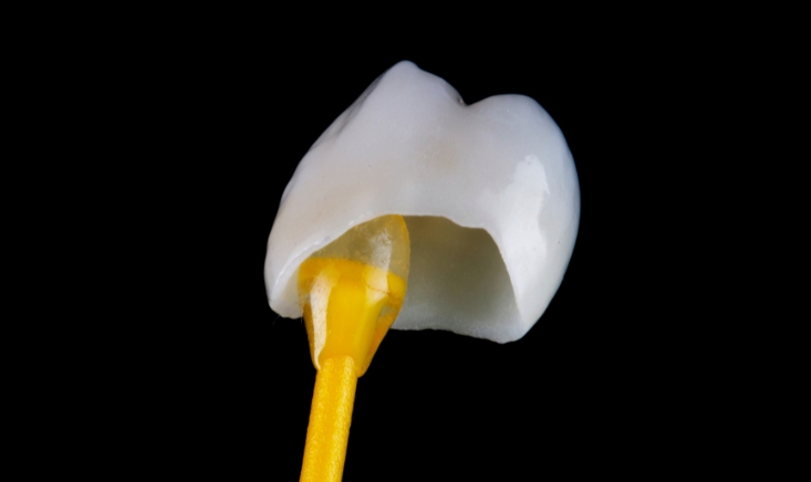 How long do crowns last on teeth