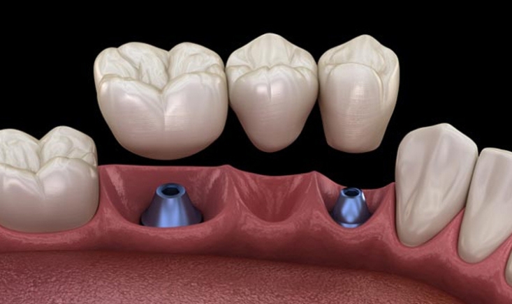 can dental implants be used for the front teeth